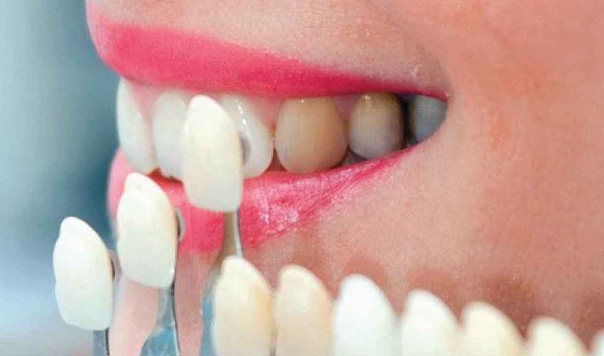 Zirconium Porcelain Veneer Lifemed Dental